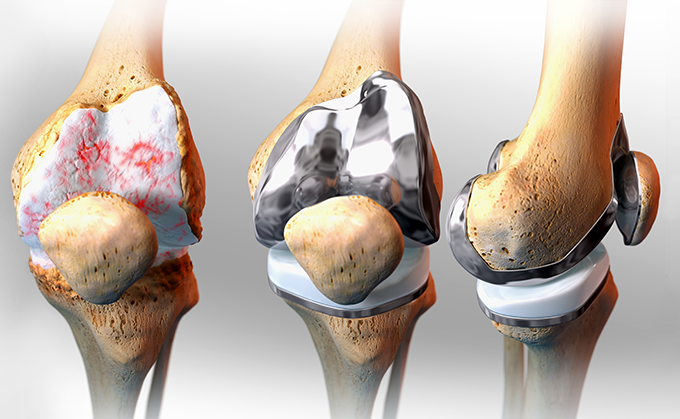 knee replacement 1